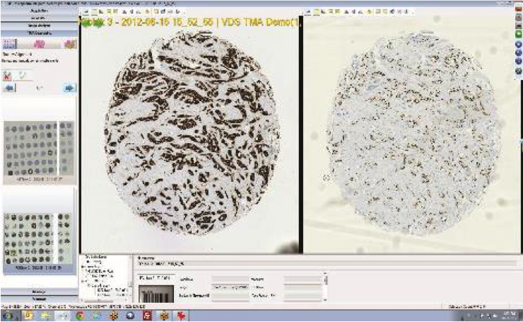 VISIOPHARM定量数字病理图像分析软件TMAworkflow