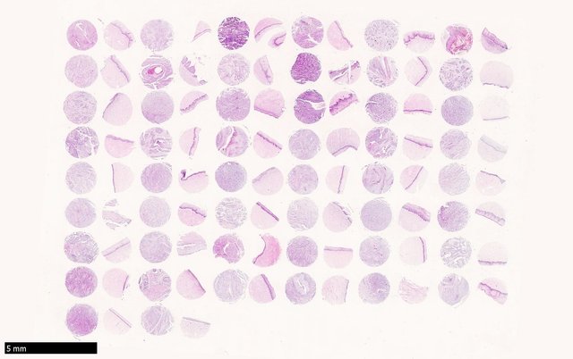 宫颈癌50例同例正常对照50例100点组织芯片